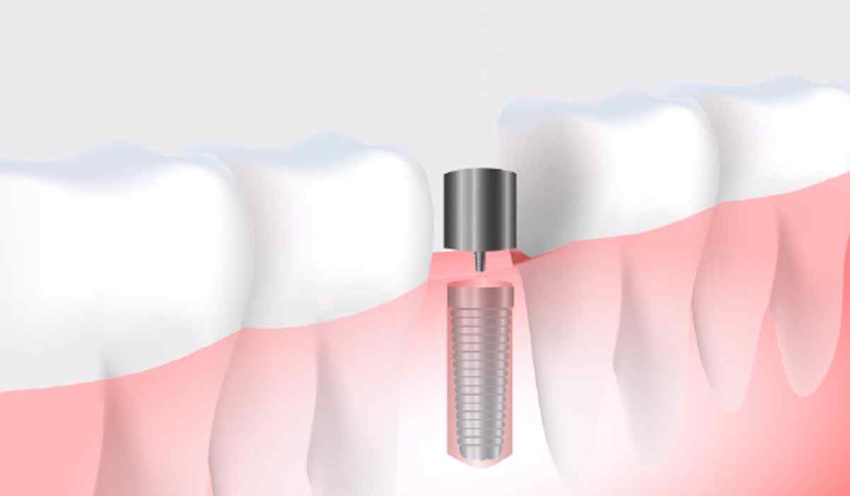 https://www.dentistenapierville.com/wp-content/uploads/2023/05/tab_image_01.jpg